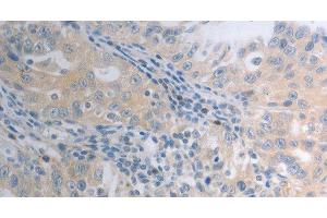 Immunohistochemistry of paraffin-embedded Human ovarian cancer tissue using SHH Polyclonal Antibody at dilution 1:40 (Sonic Hedgehog anticorps)