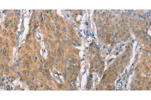 Immunohistochemistry of paraffin-embedded Human gastric cancer tissue using CEACAM6 Polyclonal Antibody at dilution 1:50 (CEACAM6 anticorps)