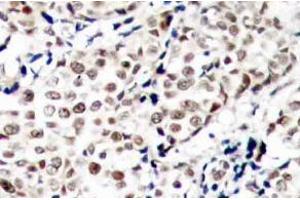 Immunohistochemistry (IHC) analysis of p-Chk1 (pSer345) pAb in paraffin-embedded human breast carcinoma tissue (CHEK1 anticorps  (pSer345))