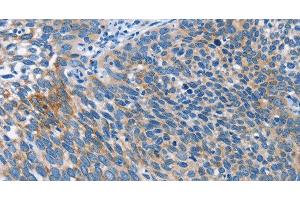 Immunohistochemistry of paraffin-embedded Human cervical cancer tissue using AHR Polyclonal Antibody at dilution 1:50 (Aryl Hydrocarbon Receptor anticorps)