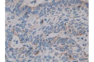 Detection of CYP21A2 in Human Skin cancer Tissue using Polyclonal Antibody to Cytochrome P450 Family 21 Subfamily A Member 2 (CYP21A2)