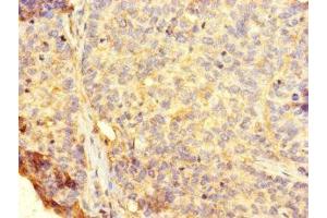Immunohistochemistry of paraffin-embedded human ovarian cancer using ABIN7154641 at dilution of 1:100 (RHEBL1 anticorps  (AA 1-180))