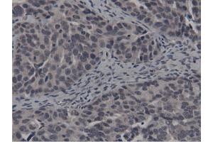 Immunohistochemical staining of paraffin-embedded Carcinoma of Human kidney tissue using anti-BTN1A1 mouse monoclonal antibody. (BTN1A1 anticorps)