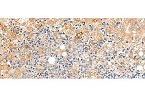 Immunohistochemistry of paraffin-embedded Human liver cancer tissue using MEST Polyclonal Antibody at dilution of 1:50(x200) (MEST anticorps)