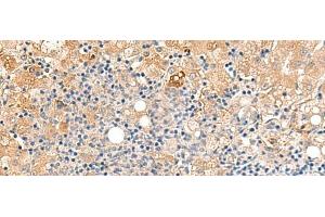 Immunohistochemistry of paraffin-embedded Human liver cancer tissue using MEST Polyclonal Antibody at dilution of 1:50(x200)