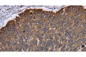 Immunohistochemistry of paraffin-embedded Human lung cancer using KRT31 Polyclonal Antibody at dilution of 1:30 (Keratin 31 anticorps)