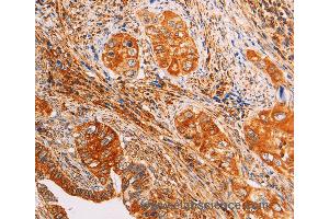 Immunohistochemistry of Human cervical cancer using SLC25A4 Polyclonal Antibody at dilution of 1:40 (SLC25A4 anticorps)