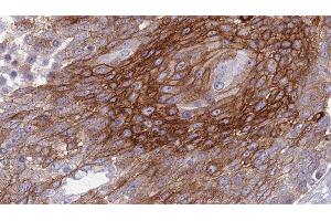 ABIN6277297 at 1/100 staining Human urothelial cancer tissue by IHC-P. (Betacellulin anticorps  (N-Term))
