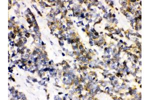 Anti- Ataxin 3 Picoband antibody, IHC(P) IHC(P): Human Lung Cancer Tissue (Ataxin 3 anticorps  (C-Term))