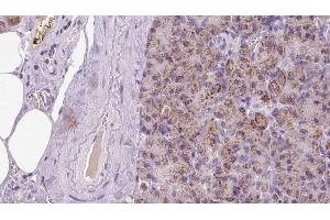 ABIN6273287 at 1/100 staining Human pancreas cancer tissue by IHC-P. (Parvin, beta anticorps  (C-Term))