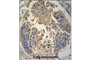 Formalin-fixed and paraffin-embedded human lung carcinoma tissue reacted with RIP3 (RIPK3) antibody (C-term) (ABIN392275 and ABIN2841945) , which was peroxidase-conjugated to the secondary antibody, followed by DAB staining.