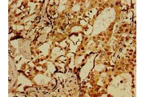 Immunohistochemistry of paraffin-embedded human breast cancer using ABIN7175658 at dilution of 1:100 (SORCS1 anticorps  (AA 34-175))