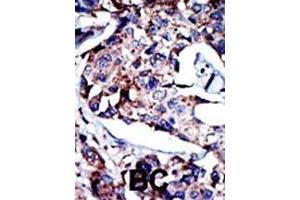 Formalin-fixed and paraffin-embedded human cancer tissue reacted with the primary antibody, which was peroxidase-conjugated to the secondary antibody, followed by DAB staining.