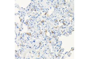 Immunohistochemistry of paraffin-embedded human colon carcinoma using  Rabbit pAb (ABIN6131167, ABIN6136429, ABIN6136430 and ABIN6216480) at dilution of 1:50 (40x lens). (ACE2 anticorps  (AA 18-250))
