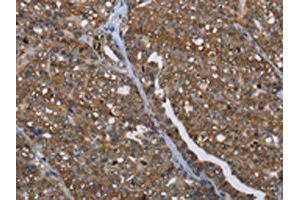 The image on the left is immunohistochemistry of paraffin-embedded Human ovarian cancer tissue using ABIN7191991(PRDM2 Antibody) at dilution 1/25, on the right is treated with synthetic peptide. (PRDM2 anticorps)