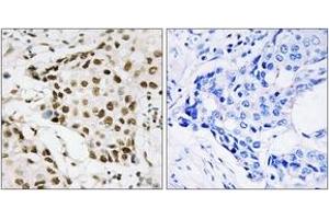 Immunohistochemistry analysis of paraffin-embedded human breast carcinoma, using NPM (Phospho-Thr199) Antibody.