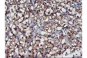 Immunohistochemical staining of paraffin-embedded Carcinoma of Human kidney tissue using anti-NNMT mouse monoclonal antibody. (NNMT anticorps)