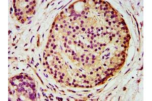 IHC image of ABIN7143720 diluted at 1:500 and staining in paraffin-embedded human pancreatic cancer performed on a Leica BondTM system.