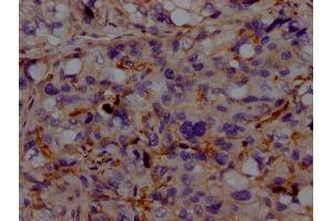 IHC image of ABIN7127322 diluted at 1:100 and staining in paraffin-embedded human liver cancer performed on a Leica BondTM system.