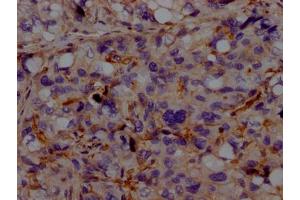 IHC image of ABIN7127322 diluted at 1:100 and staining in paraffin-embedded human liver cancer performed on a Leica BondTM system. (Recombinant ACVRL1 anticorps)