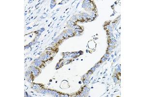 Immunohistochemistry of paraffin-embedded human colon carcinoma using G Rabbit pAb (ABIN6131444, ABIN6140942, ABIN6140944 and ABIN6218180) at dilution of 1:100 (40x lens). (GALNT3 anticorps  (AA 1-140))