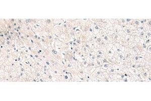 Immunohistochemistry of paraffin-embedded Human liver cancer tissue using FGFR4 Polyclonal Antibody at dilution of 1:25(x200) (FGFR4 anticorps)