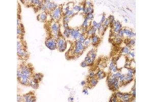 Immunohistochemistry of paraffin-embedded Human liver cancer using GLUD2 Polyclonal Antibody at dilution of 1:100 (40x lens). (GLUD2 anticorps)