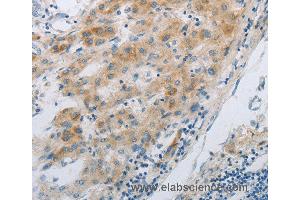 Immunohistochemistry of Human liver cancer using GJB6 Polyclonal Antibody at dilution of 1:30 (GJB6 anticorps)