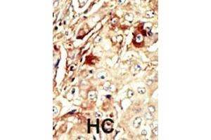 Formalin-fixed and paraffin-embedded human cancer tissue reacted with the primary antibody, which was peroxidase-conjugated to the secondary antibody, followed by AEC staining.