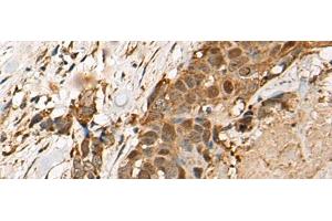 Immunohistochemistry of paraffin-embedded Human thyroid cancer tissue using HEATR9 Polyclonal Antibody at dilution of 1:110(x200) (C17orf66 anticorps)