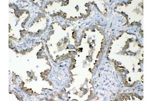 IHC testing of FFPE human lung cancer tissue with DYNLT1 antibody at 1ug/ml. (DYNLT1 anticorps)