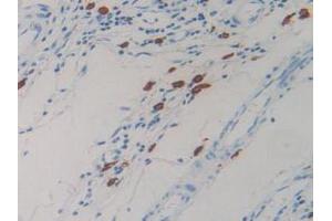 IHC-P analysis of Human Rectum Cancer Tissue, with DAB staining. (Resistin anticorps  (AA 17-108))