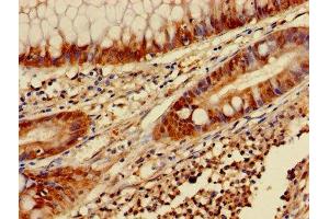 Immunohistochemistry of paraffin-embedded human colon cancer using ABIN7153453 at dilution of 1:100