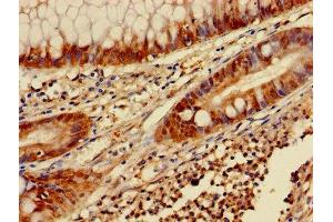 Immunohistochemistry of paraffin-embedded human colon cancer using ABIN7153453 at dilution of 1:100 (Galectin 3 anticorps  (AA 2-250))
