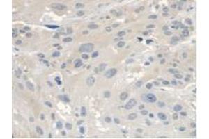 IHC-P analysis of Human Esophagus Cancer Tissue, with DAB staining. (ANTXR2 anticorps  (AA 34-318))