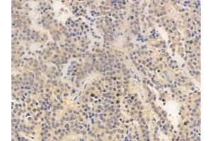 ABIN6263785 and ABIN6266653 at 1/100 staining human pituitary adenoma by IHC-P.