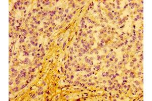 IHC image of ABIN7149142 diluted at 1:100 and staining in paraffin-embedded human colon cancer performed on a Leica BondTM system.