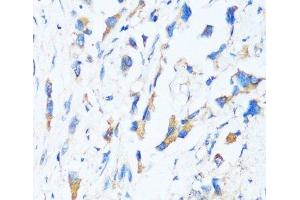 Immunohistochemistry of paraffin-embedded Human lung cancer using BAG3 Polyclonal Antibody at dilution of 1:100 (40x lens).