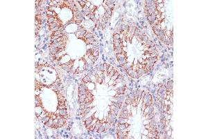 Immunohistochemistry of paraffin-embedded human colon carcinoma using HIGD1A antibody (ABIN7267642) at dilution of 1:100 (40x lens). (HIGD1A anticorps  (AA 1-93))