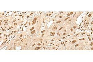Immunohistochemistry of paraffin-embedded Human esophagus cancer tissue using ZNF274 Polyclonal Antibody at dilution of 1:35(x200) (ZNF274 anticorps)