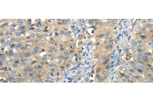 Immunohistochemistry of paraffin-embedded Human breast cancer using ISM2 Polyclonal Antibody at dilution of 1/45 (Isthmin 2 anticorps)