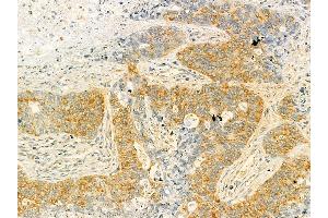 HDLBP Mouse Monoclonal Antibody at 1/100 staining human lung cancer and adjacent non-tumor tissue by IHC-P. (HDLBP anticorps  (N-Term))