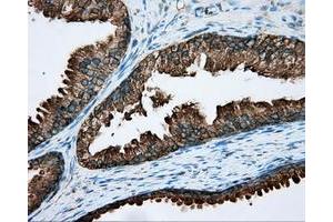 Immunohistochemical staining of paraffin-embedded Carcinoma of liver tissue using anti-RDH11 mouse monoclonal antibody. (RDH11 anticorps)