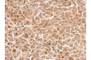 IHC-P Image KLRC1 antibody [N1N2], N-term detects KLRC1 protein at cytosol on H1299 xenograft by immunohistochemical analysis. (KLRC1 anticorps  (N-Term))