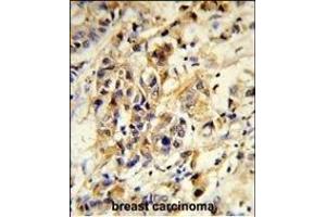 Formalin-fixed and paraffin-embedded human breast carcinoma reacted with RPGRIP1 Antibody (Center), which was peroxidase-conjugated to the secondary antibody, followed by DAB staining. (RPGRIP1 anticorps  (AA 530-557))