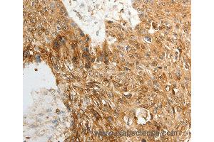 Immunohistochemistry of Human ovarian cancer using TENM3 Polyclonal Antibody at dilution of 1:50 (TENM3 anticorps)
