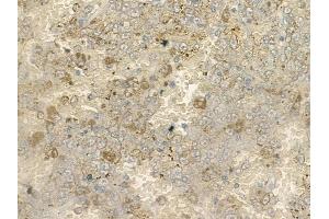 ABIN6260902 and ABIN6273102 at 1/100 staining human melanoma by IHC-P. (CMIP anticorps  (C-Term))