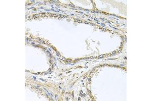 Immunohistochemistry of paraffin-embedded human prostate using TNFRSF10A antibody (ABIN5973697) at dilution of 1/100 (40x lens). (TNFRSF10A anticorps)