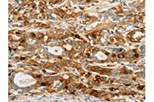 The image on the left is immunohistochemistry of paraffin-embedded Human gastic cancer tissue using ABIN7130484(OASL Antibody) at dilution 1/20, on the right is treated with fusion protein. (OASL anticorps)