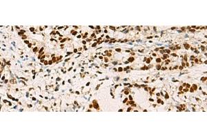 Immunohistochemistry of paraffin-embedded Human cervical cancer tissue using ELF5 Polyclonal Antibody at dilution of 1:70(x200) (ELF5 anticorps)